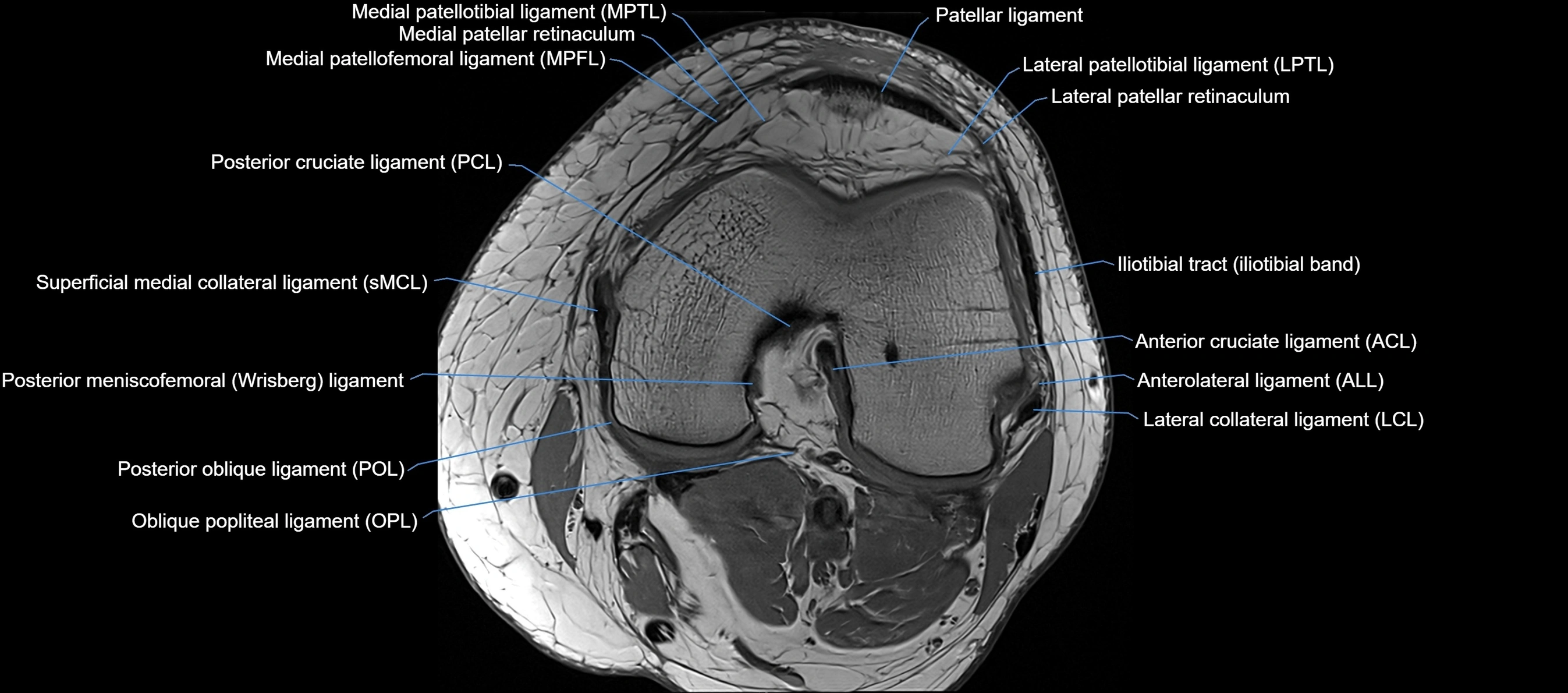 MRI Knee axial  ligaments cross sectional anatomy 3T  radiology  image-img-03001-00023.webp
